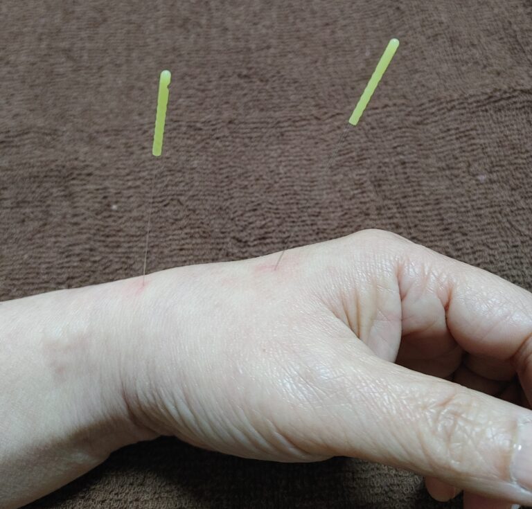 鍼って痛い？こわい？ | 美容鍼 マッサージ鍼灸院 すまいる すとれーじ とも